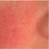 1.4b Focus on - Flushing, erythrosis, blotchiness and rosacea_illu 1