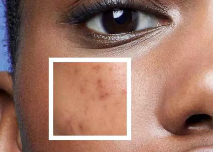 Acne