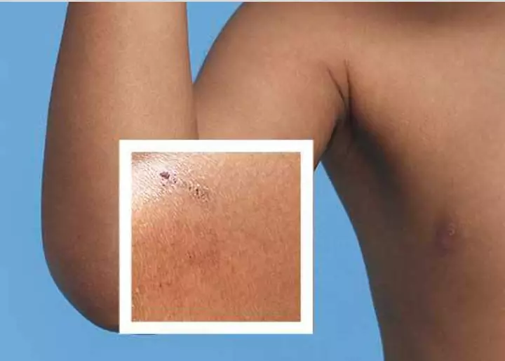 Eczema