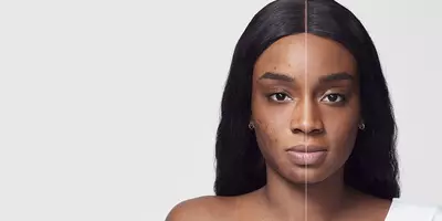 Everything You Need to Know About Age Spots