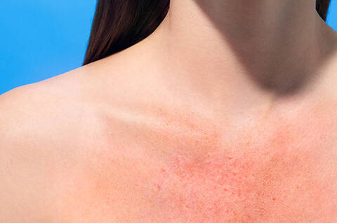 How to avoid skin allergic reactions: 8 top tips