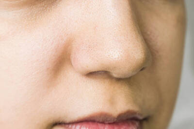 What are blackheads?