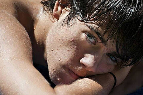 Acne marks and scars: how to remove them