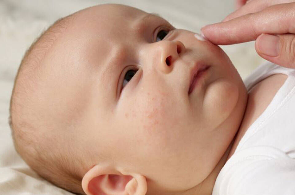 How to Relieve Your Baby’s Eczema-Prone Skin