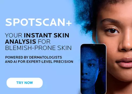 Half-face portrait of a young woman alongside her digital skin analysis on a smartphone, illustrating before and after skin condition.