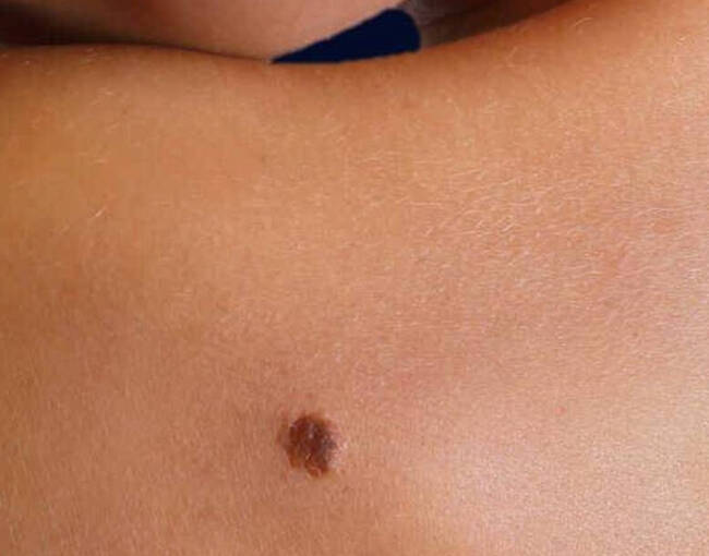 Melanoma Prevention Image