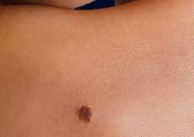 Melanoma Prevention Image