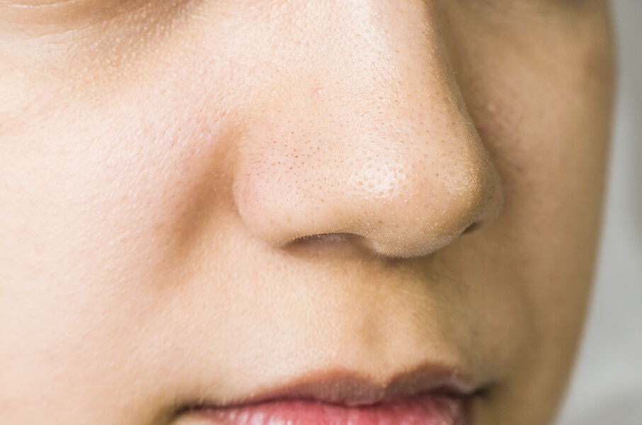 Qu’estce que les points noirs? L'Édito Peau