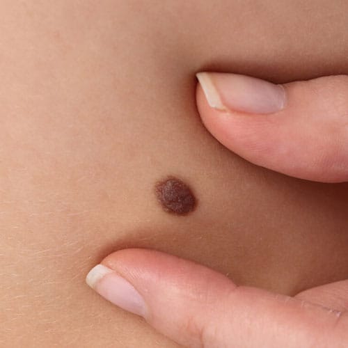 Mole exam, nothing complicated