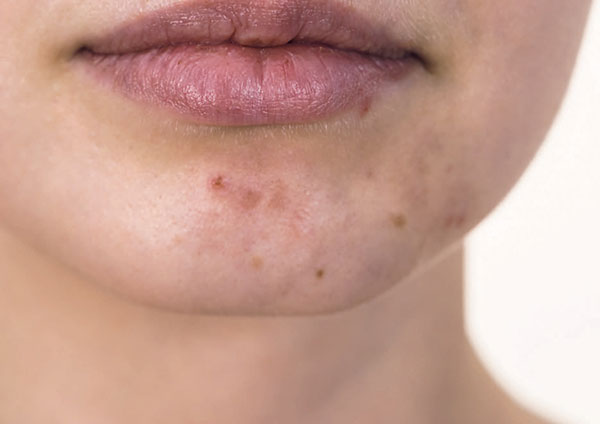 How do I treat folliculitis?