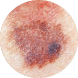 Diameter | Malignant
