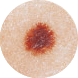 Diameter | Benign